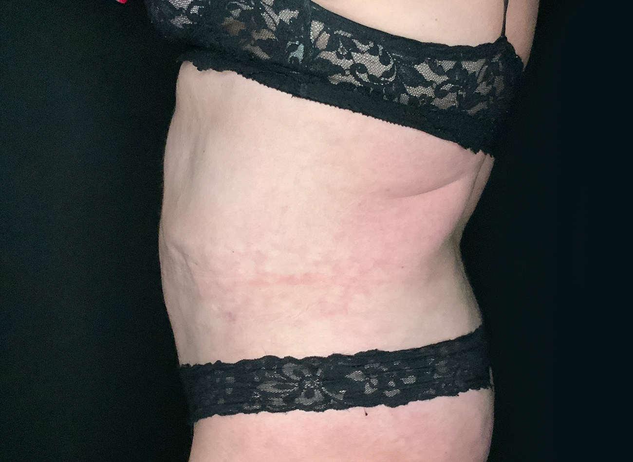 Patient #49717: Liposuction After Image