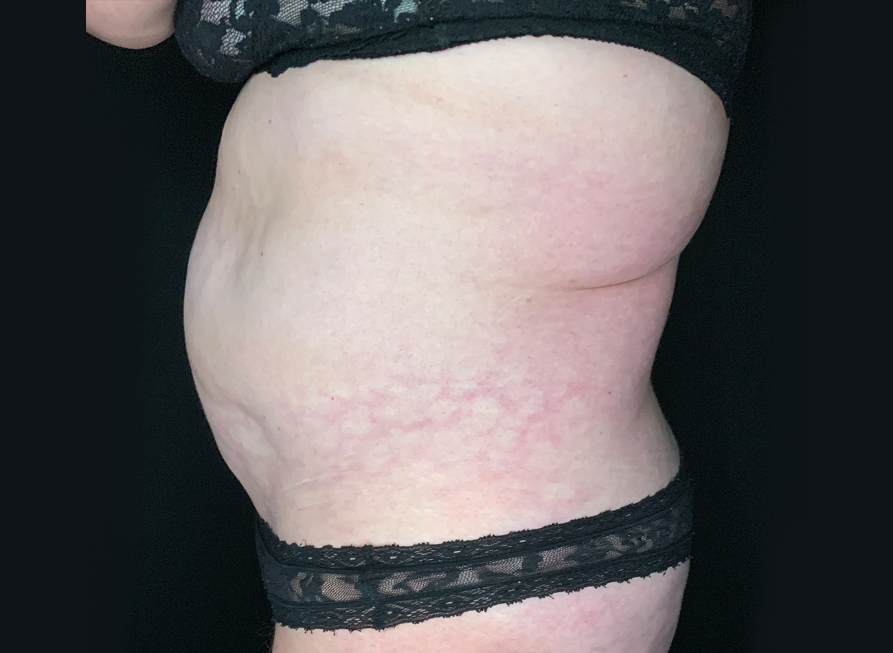 Patient #49717: Liposuction Before Image