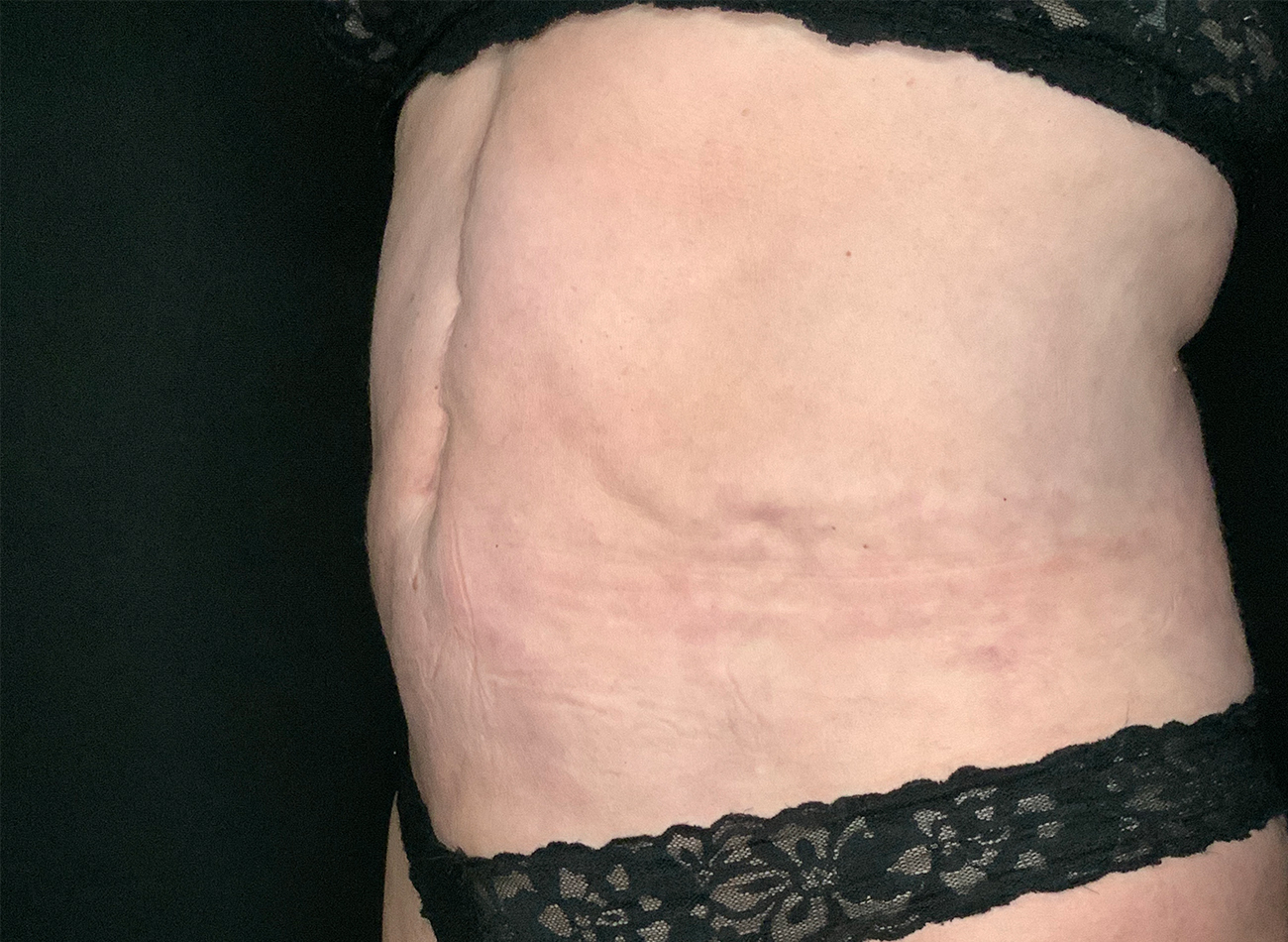 Patient #49717: Liposuction After Image