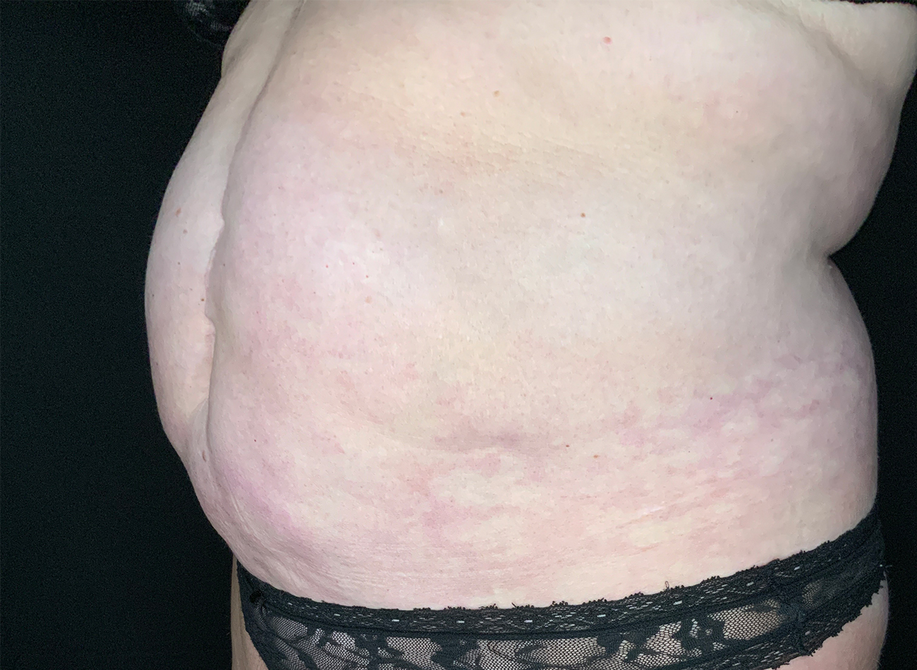 Patient #49717: Liposuction Before Image