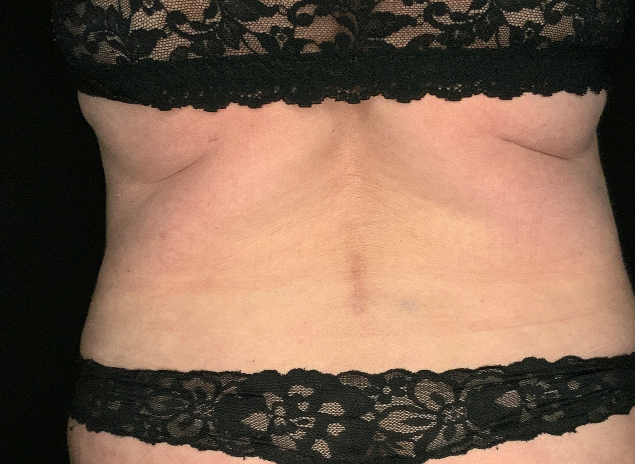 Patient #49717: Liposuction After Image
