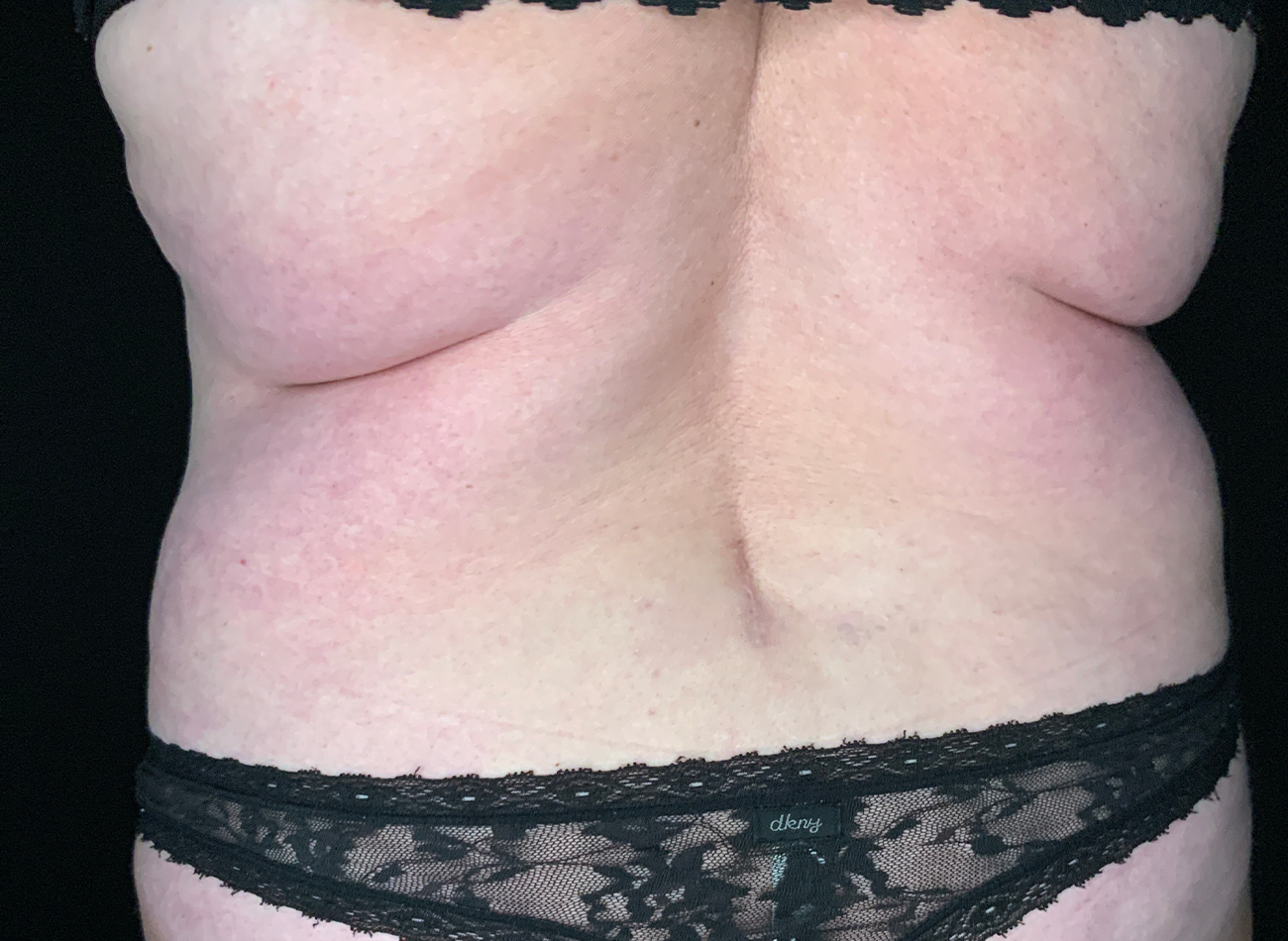 Patient #49717: Liposuction Before Image