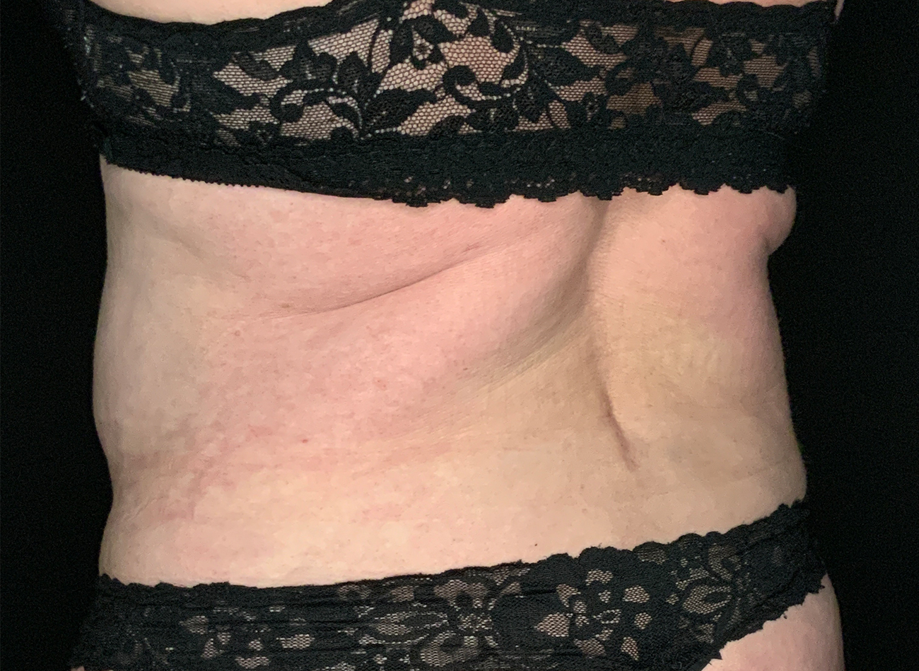 Patient #49717: Liposuction After Image