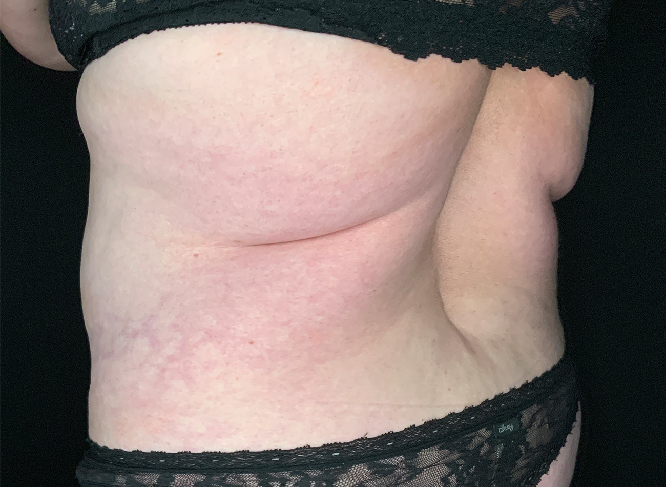 Patient #49717: Liposuction Before Image