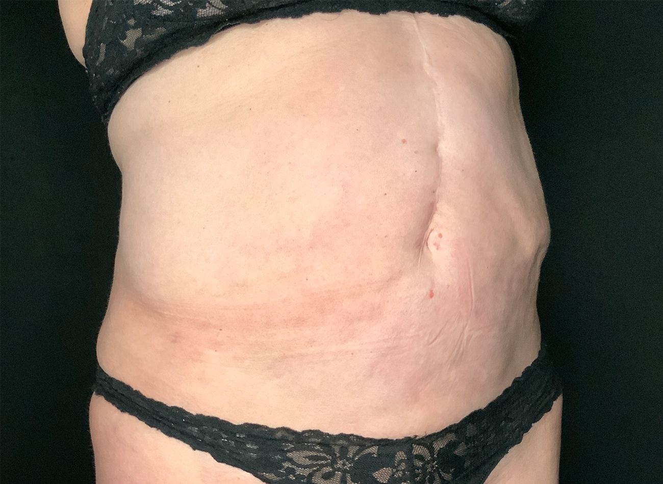 Patient #49717: Liposuction After Image