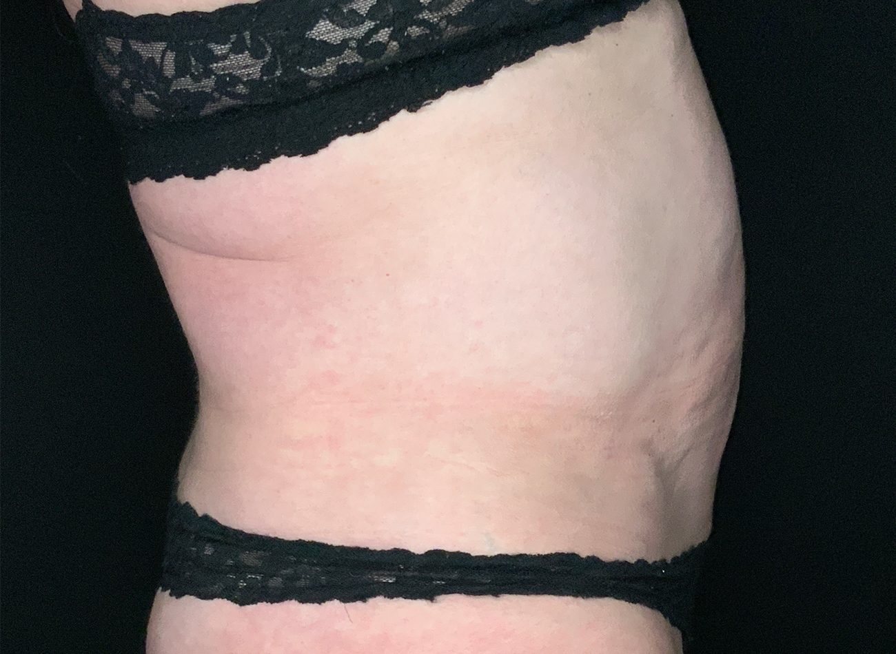 Patient #49717: Liposuction After Image