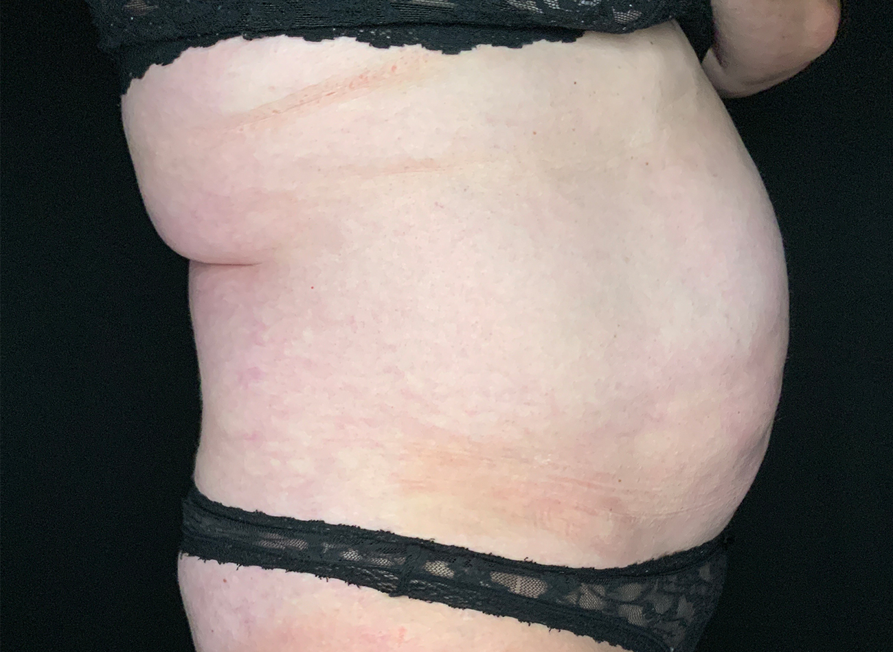 Patient #49717: Liposuction Before Image