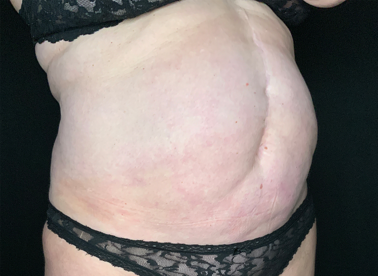 Patient #49717: Liposuction Before Image