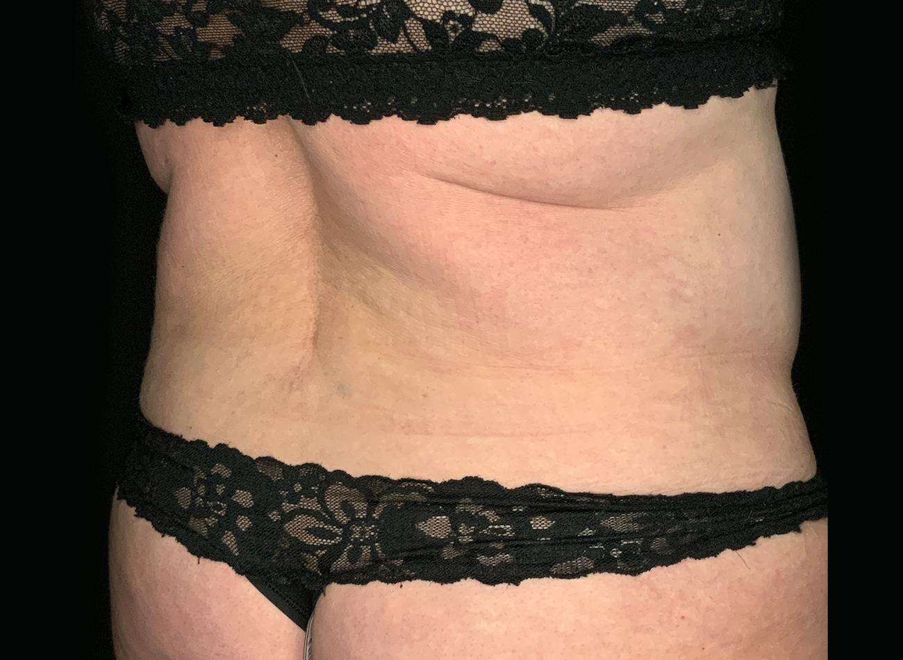Patient #49717: Liposuction After Image