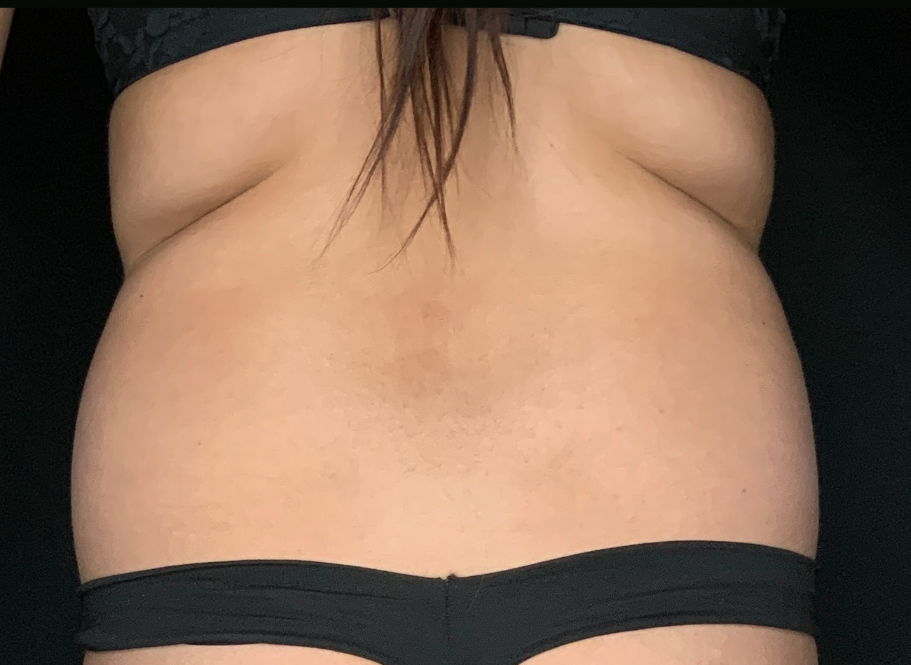 Patient #69141-1: Liposuction to Back, Abdomen, and Thighs Before Image