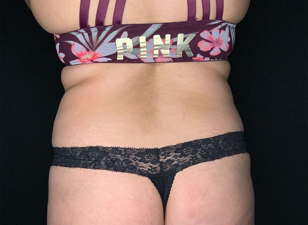 Patient #92051-01: Liposuction to Abdomen, Back, and Flanks Before Image