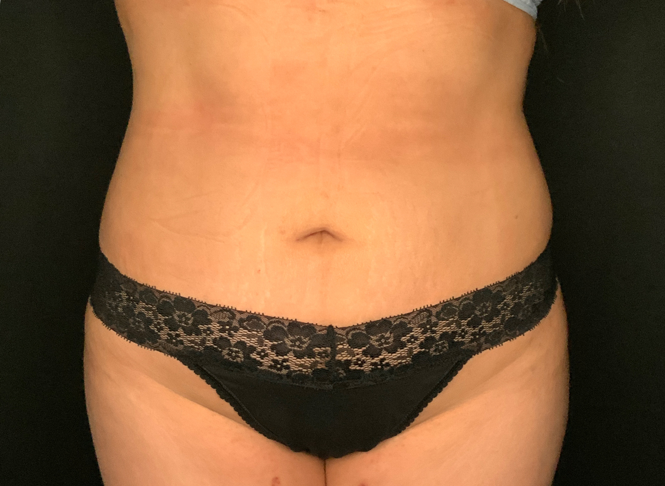 Patient #92051-01: Liposuction to Abdomen, Back, and Flanks After Image