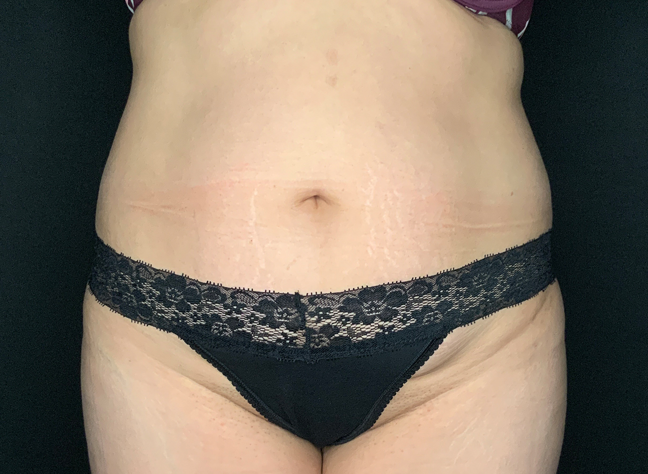 Patient #92051-01: Liposuction to Abdomen, Back, and Flanks Before Image