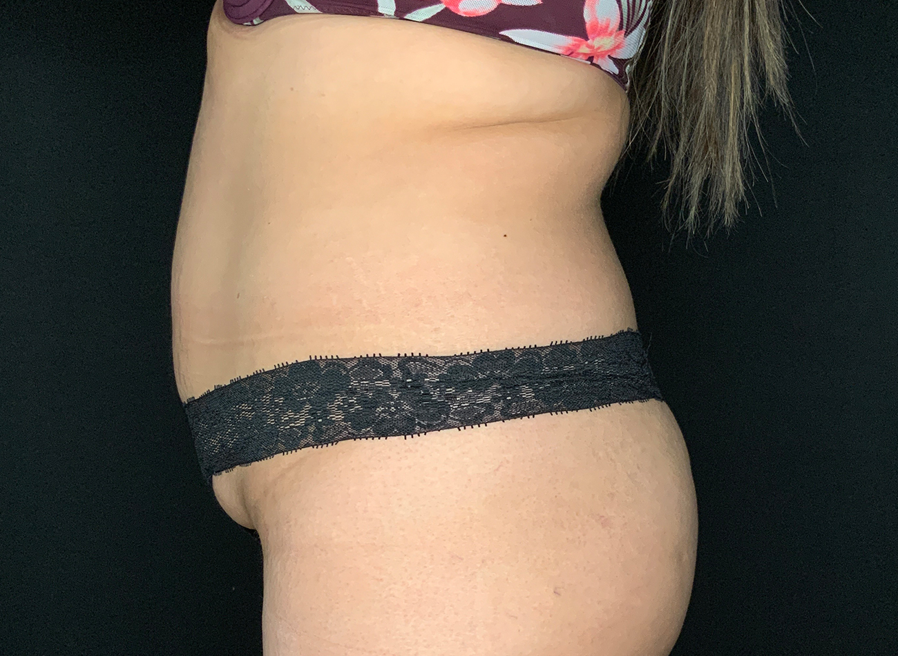 Patient #92051-01: Liposuction to Abdomen, Back, and Flanks Before Image