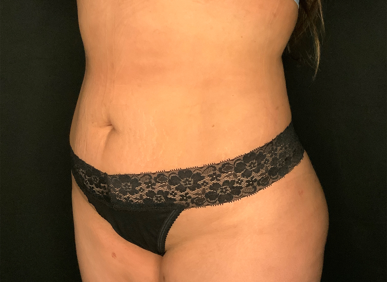 Patient #92051-01: Liposuction to Abdomen, Back, and Flanks After Image