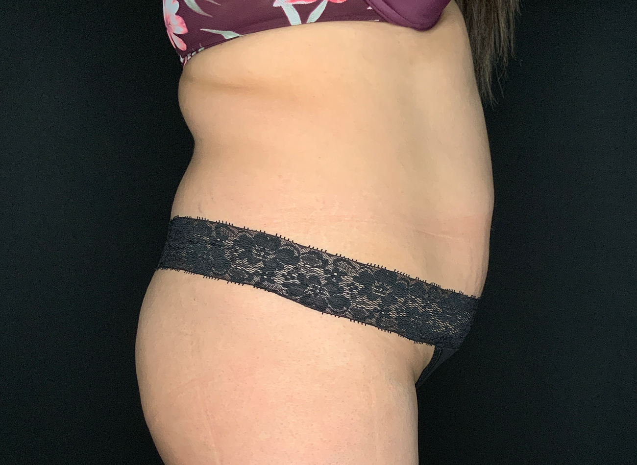 Patient #92051-01: Liposuction to Abdomen, Back, and Flanks Before Image