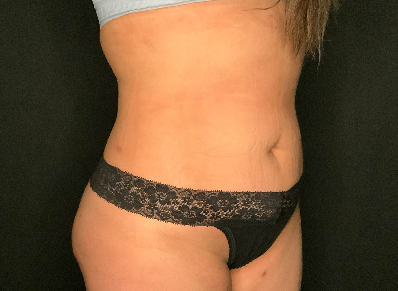 Patient #92051-01: Liposuction to Abdomen, Back, and Flanks After Image