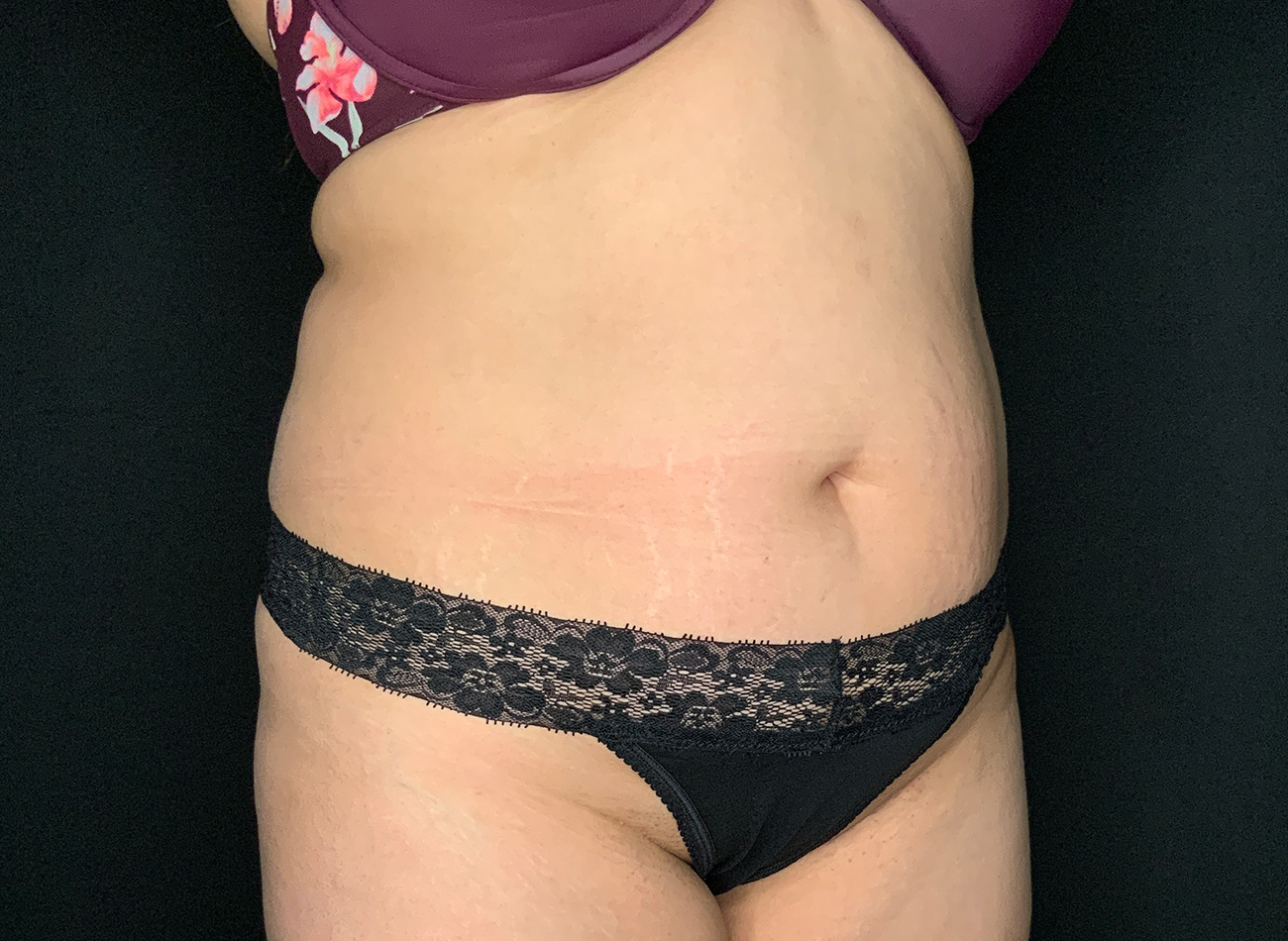 Patient #92051-01: Liposuction to Abdomen, Back, and Flanks Before Image