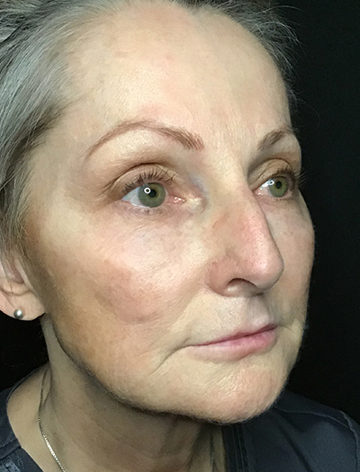 Patient #11739: Liquid Facelift After Image