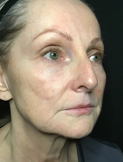 Patient #11739: Liquid Facelift Before Image