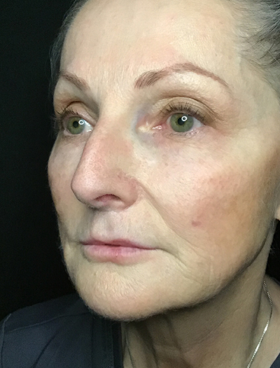 Patient #11739: Liquid Facelift After Image