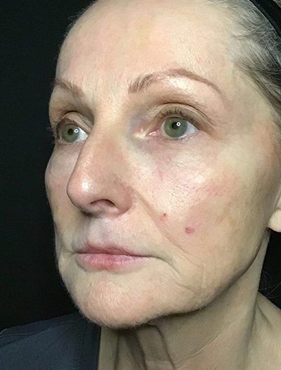 Patient #11739: Liquid Facelift Before Image