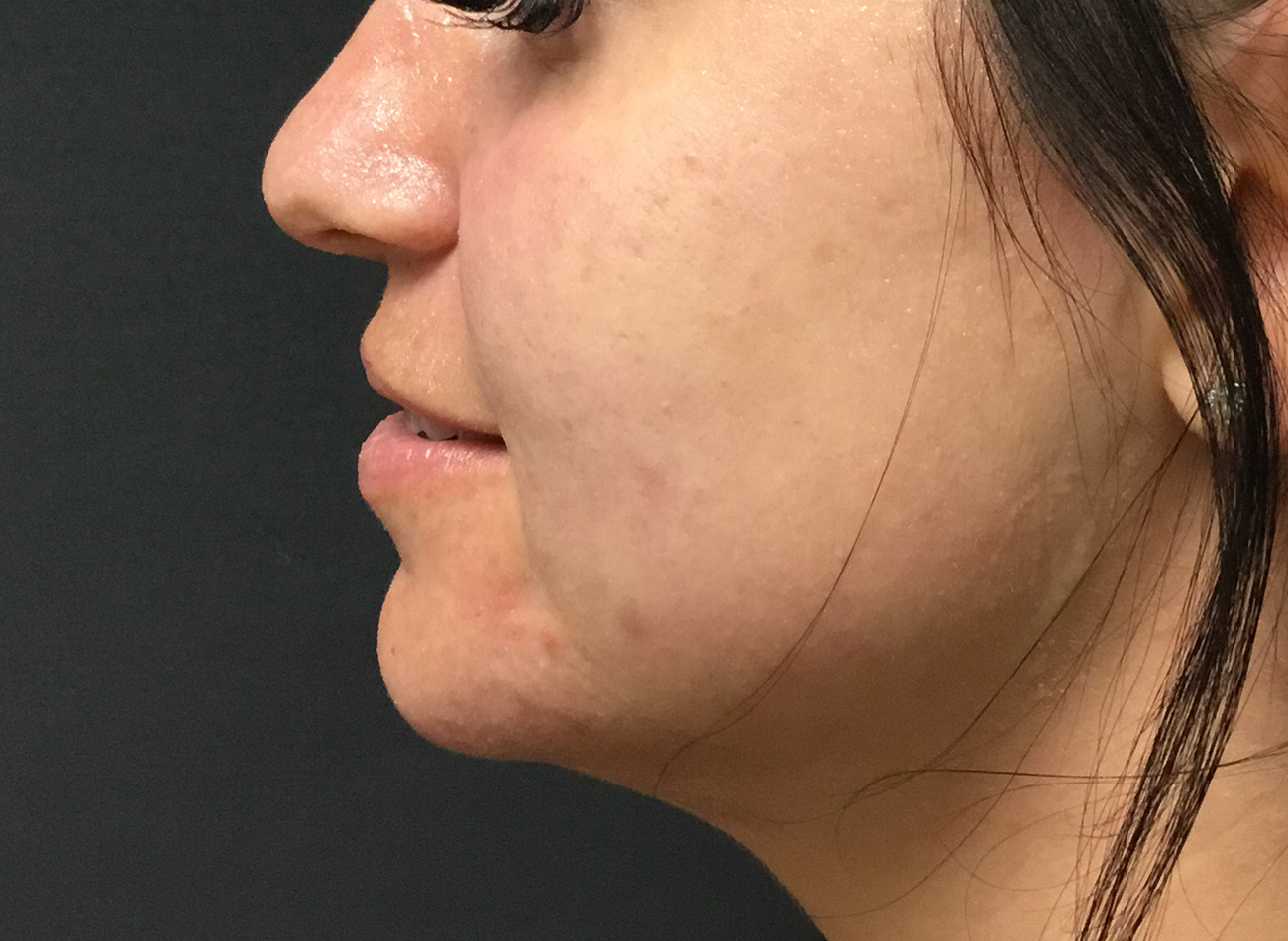 Patient #33225: Microneedling Before Image