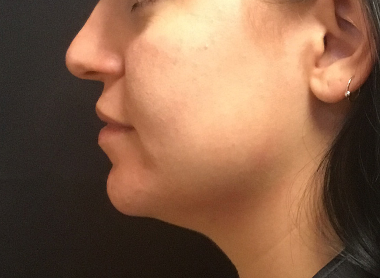 Patient #33225: Microneedling After Image