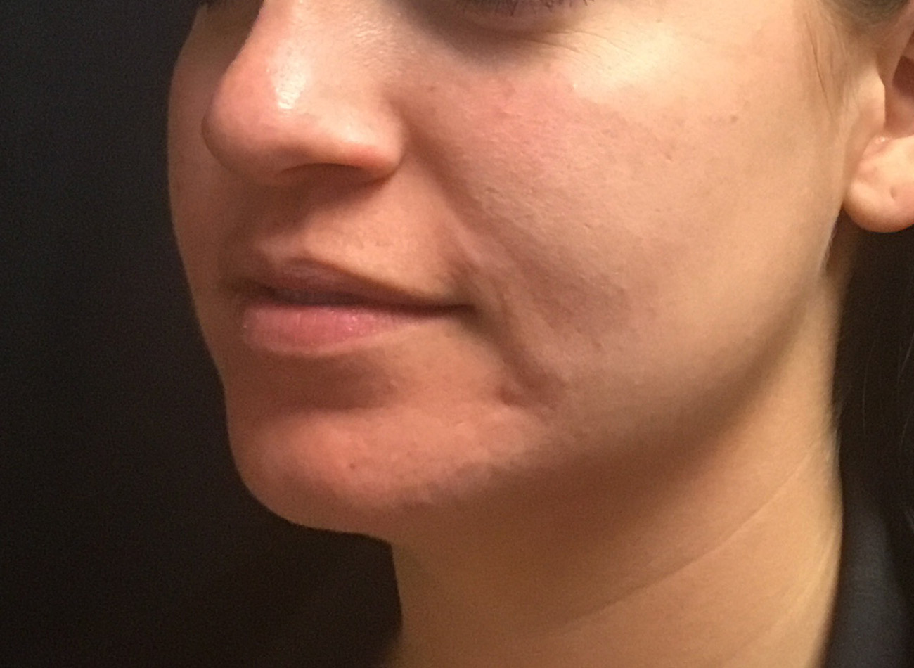 Patient #33225: Microneedling After Image