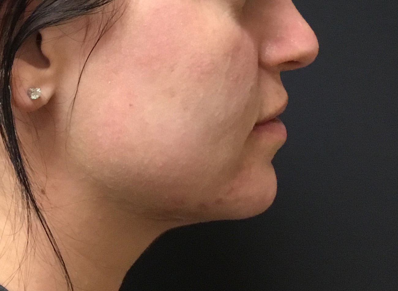 Patient #33225: Microneedling Before Image