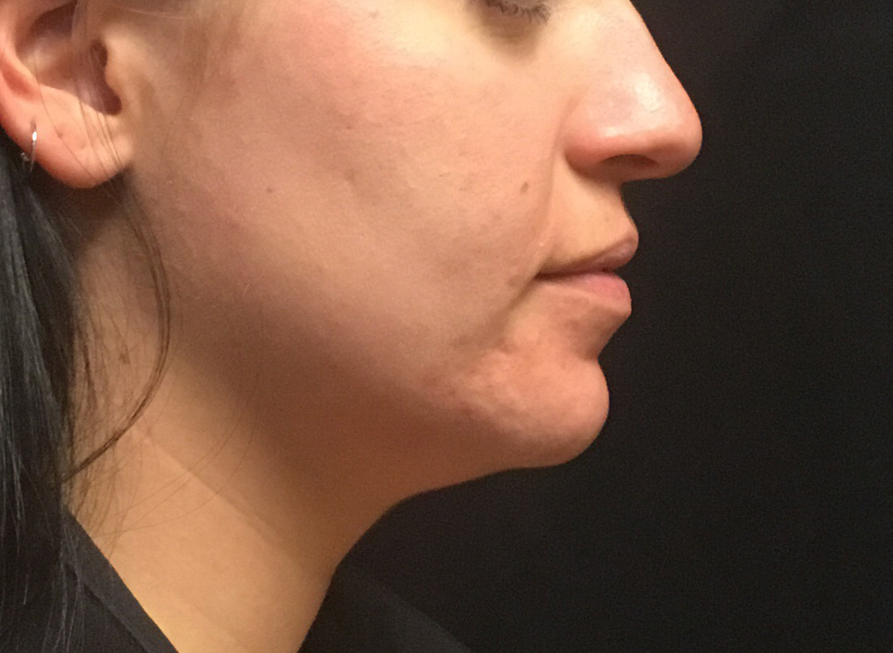 Patient #33225: Microneedling After Image