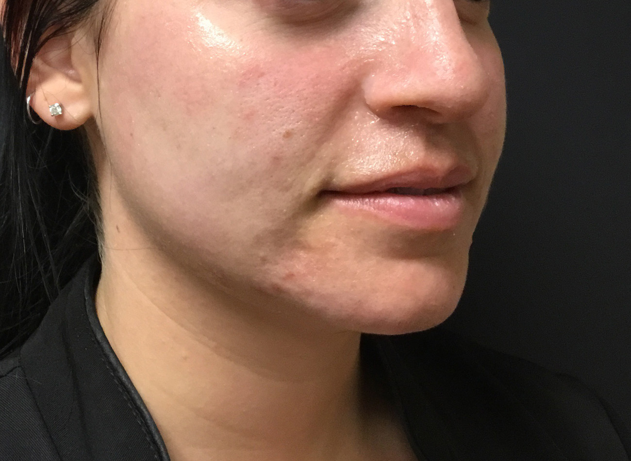 Patient #33225: Microneedling Before Image