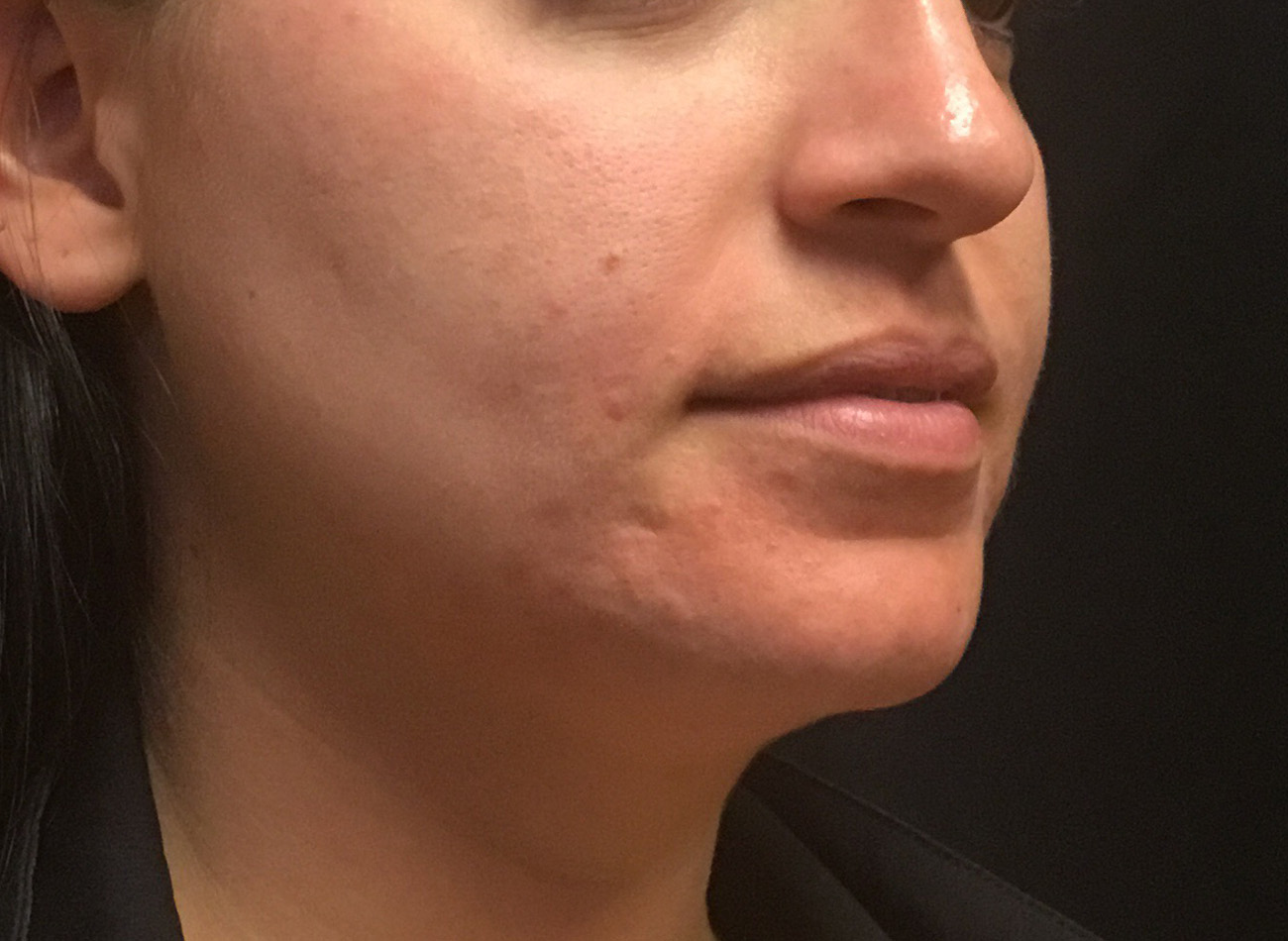 Patient #33225: Microneedling After Image