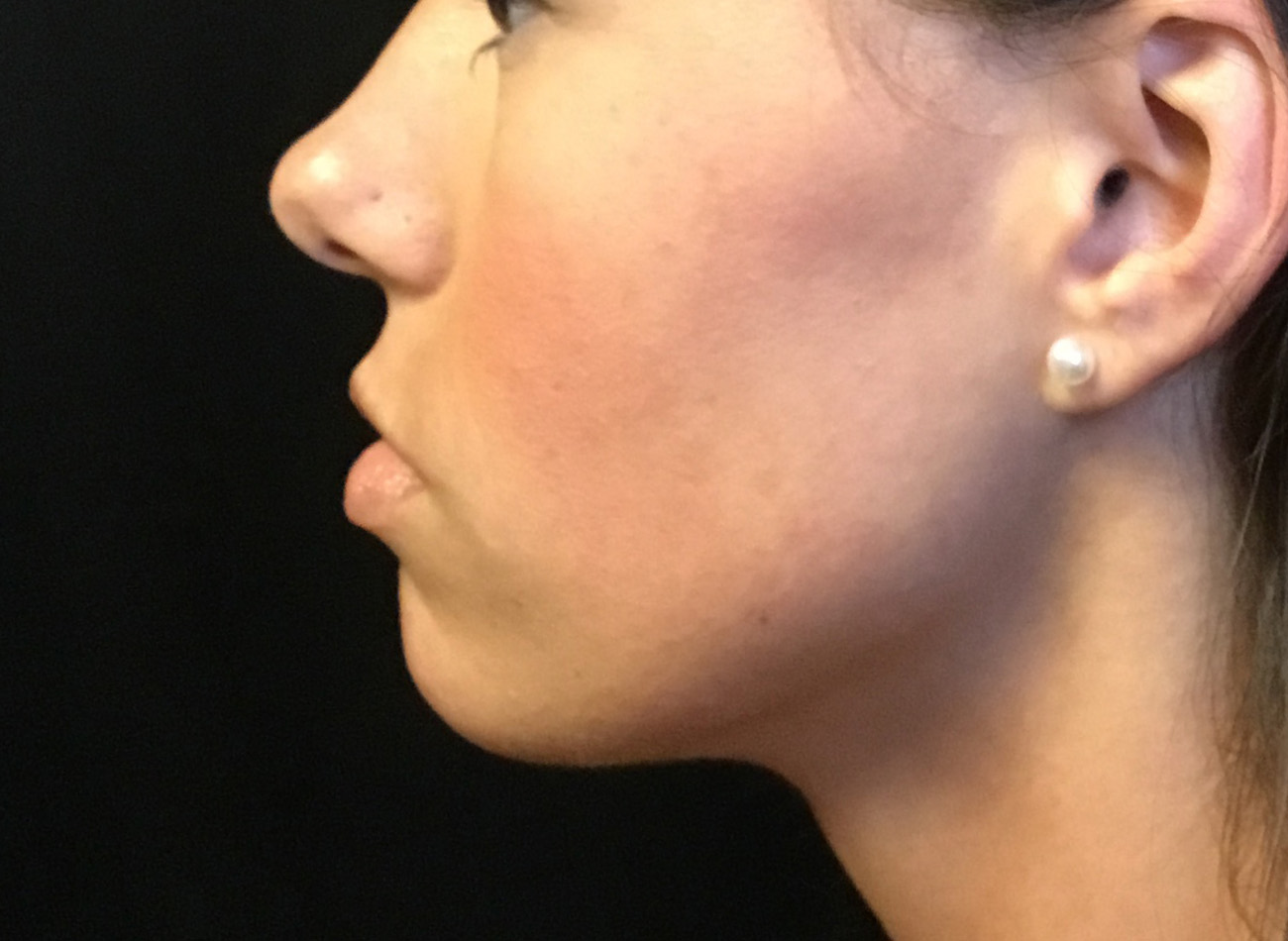 Patient #38347: Microneedling After Image