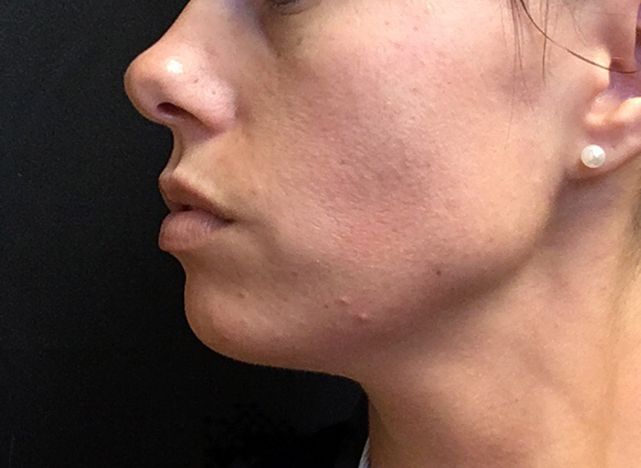 Patient #38347: Microneedling Before Image
