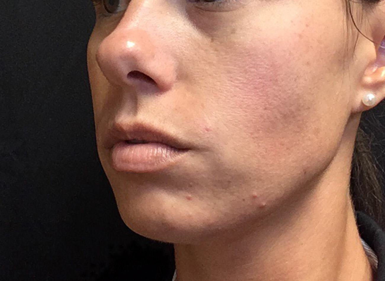 Patient #38347: Microneedling Before Image