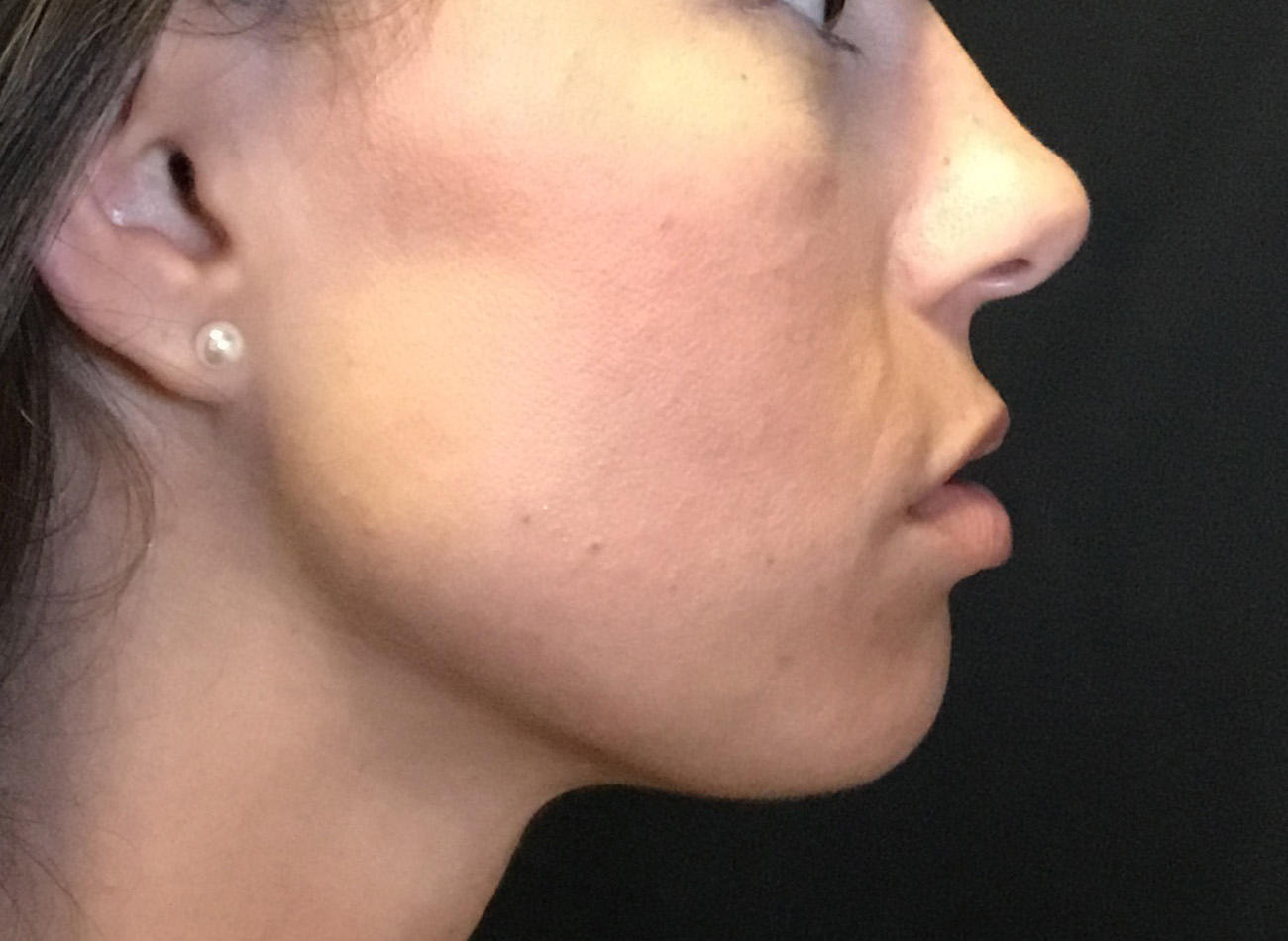 Patient #38347: Microneedling After Image
