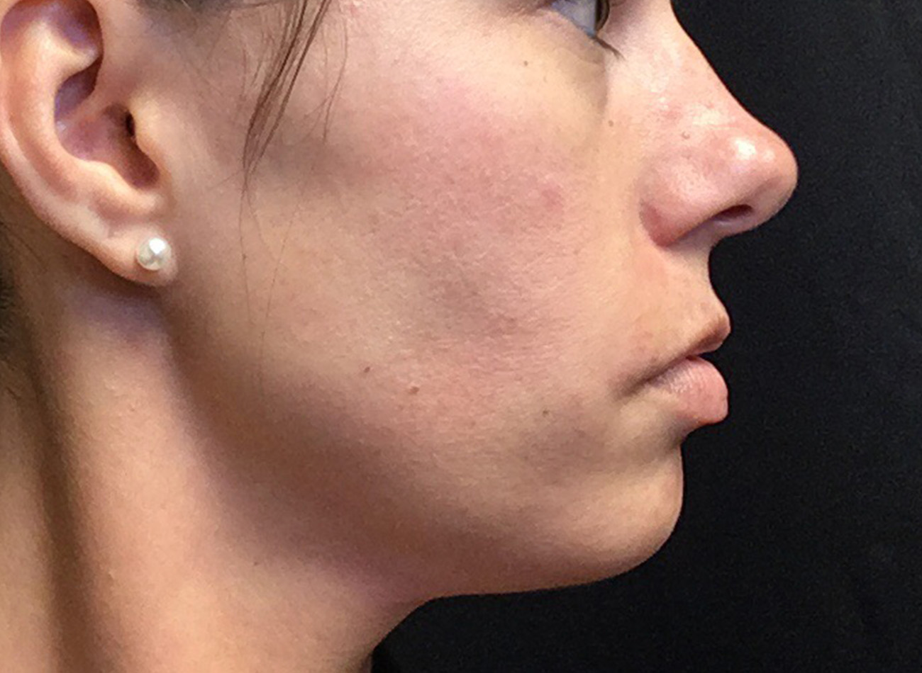 Patient #38347: Microneedling Before Image