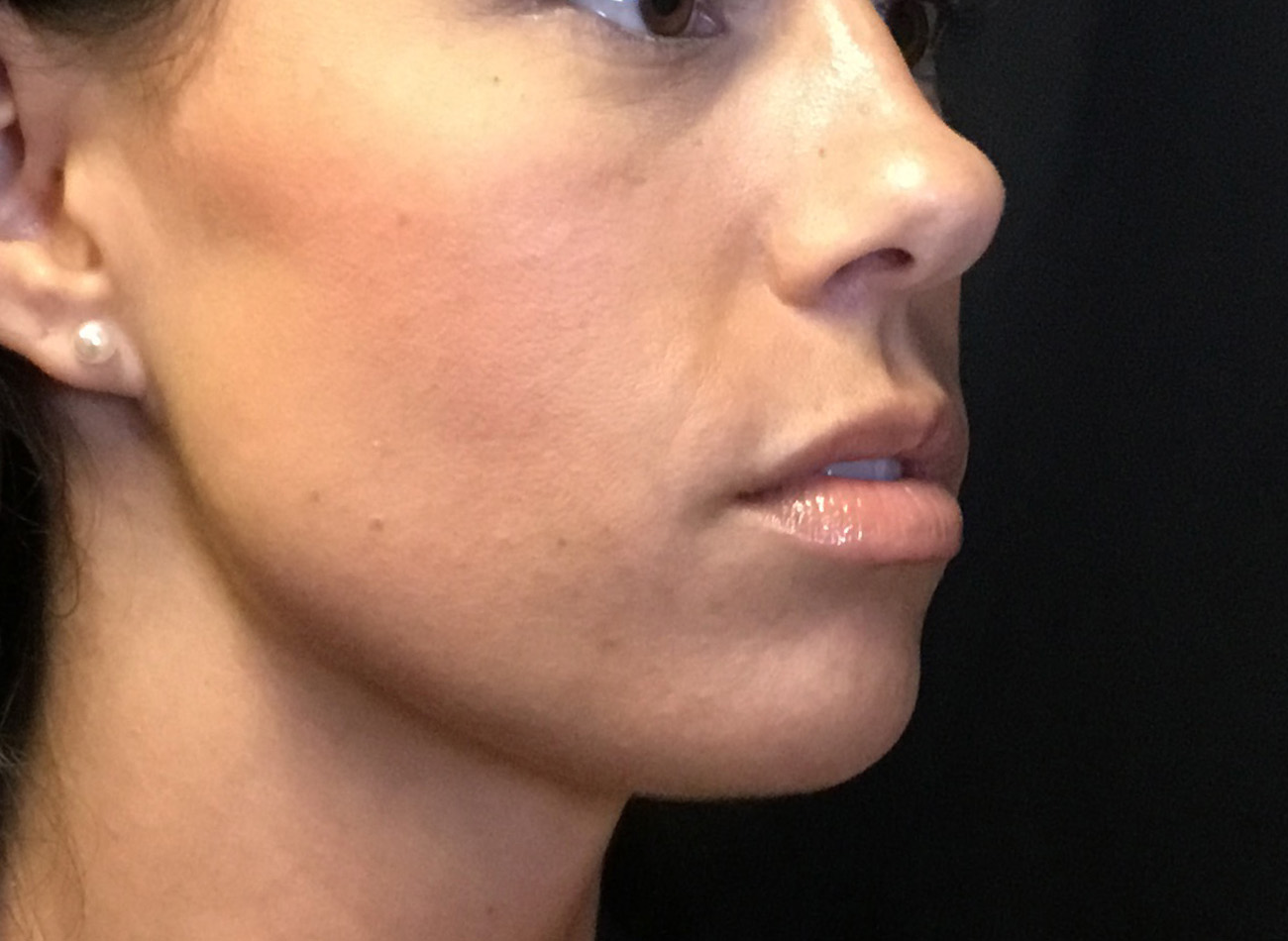 Patient #38347: Microneedling After Image