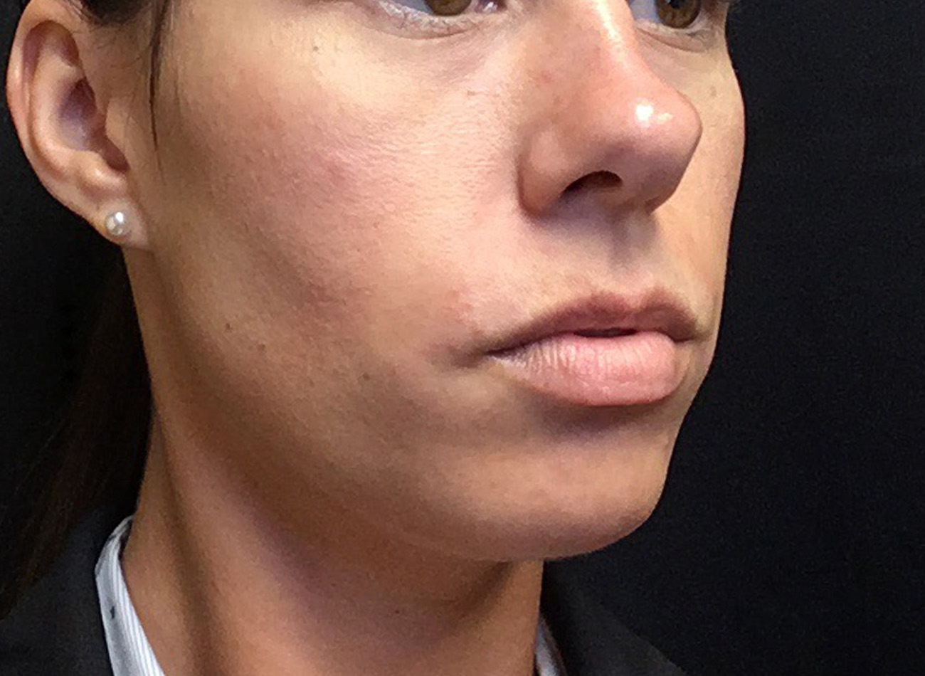 Patient #38347: Microneedling Before Image