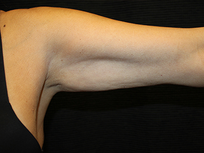 Patient #19169: Brachioplasty Before Image