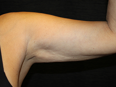 Patient #19169: Brachioplasty Before Image