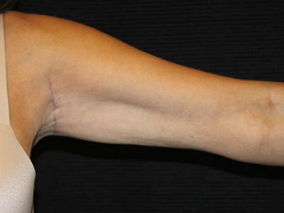 Patient #19169: Brachioplasty After Image