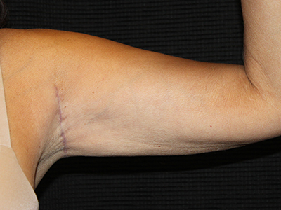 Patient #19169: Brachioplasty After Image