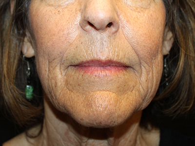 Patient #63871: CO2 Laser Before Image