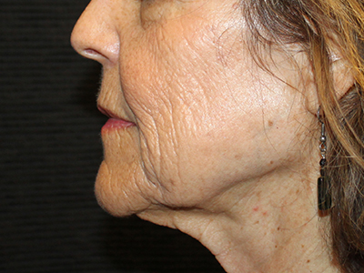 Patient #63871: CO2 Laser Before Image