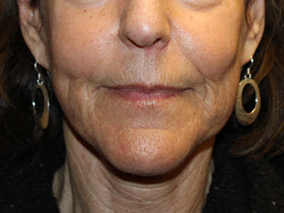 Patient #63871: CO2 Laser After Image