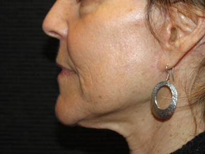 Patient #63871: CO2 Laser After Image