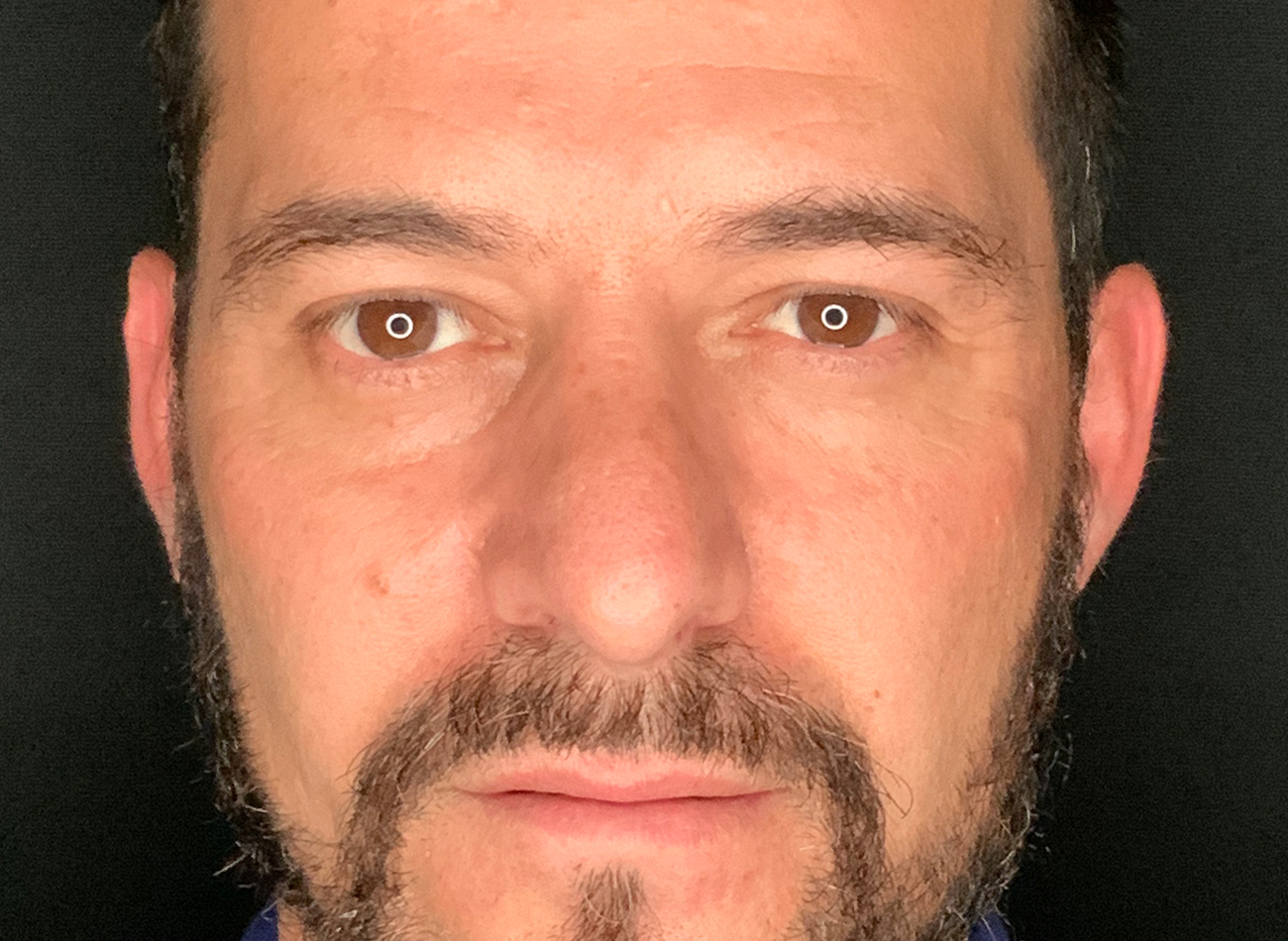 Patient #11645: Rhinoplasty After Image