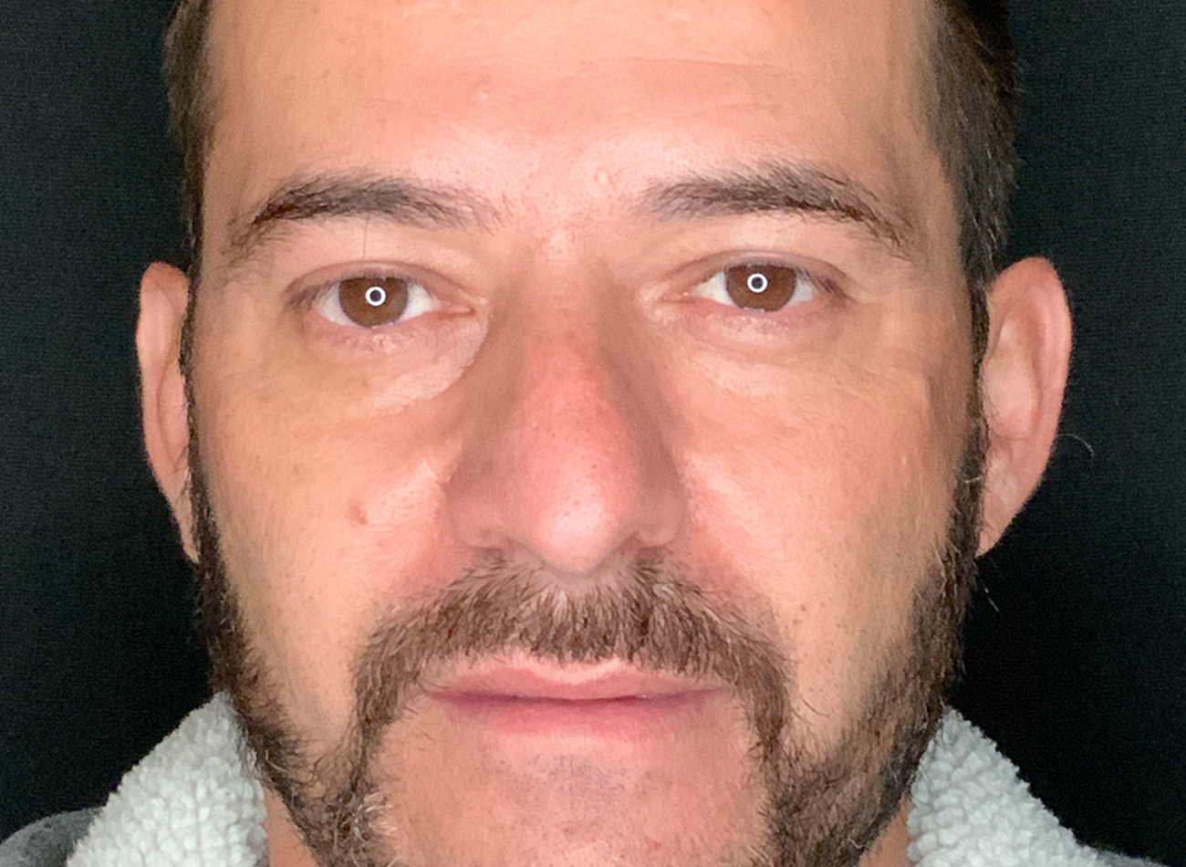 Patient #11645: Rhinoplasty Before Image